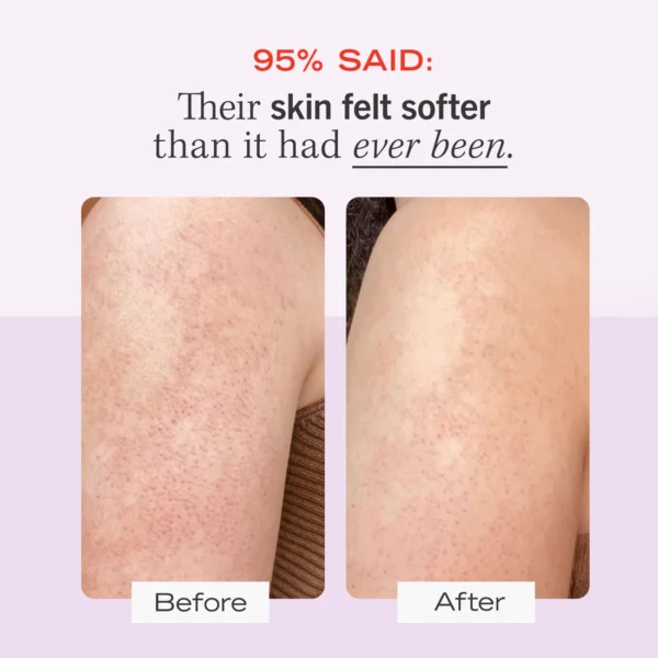 First Aid Beauty KP Bump Eraser Body Scrub – Exfoliating Scrub for Smooth, Clear Skin - Image 5